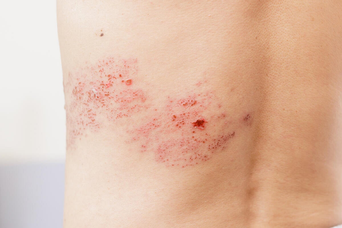 ಸಮಯಸಾಧಕ ಸೋಂಕುಗಳು