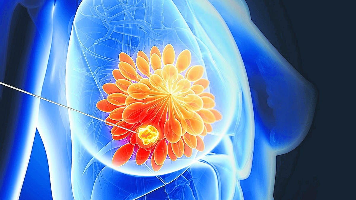 ಆರೋಗ್ಯ: ಕೃತಕ ಸ್ತನ, ವರದಾನ