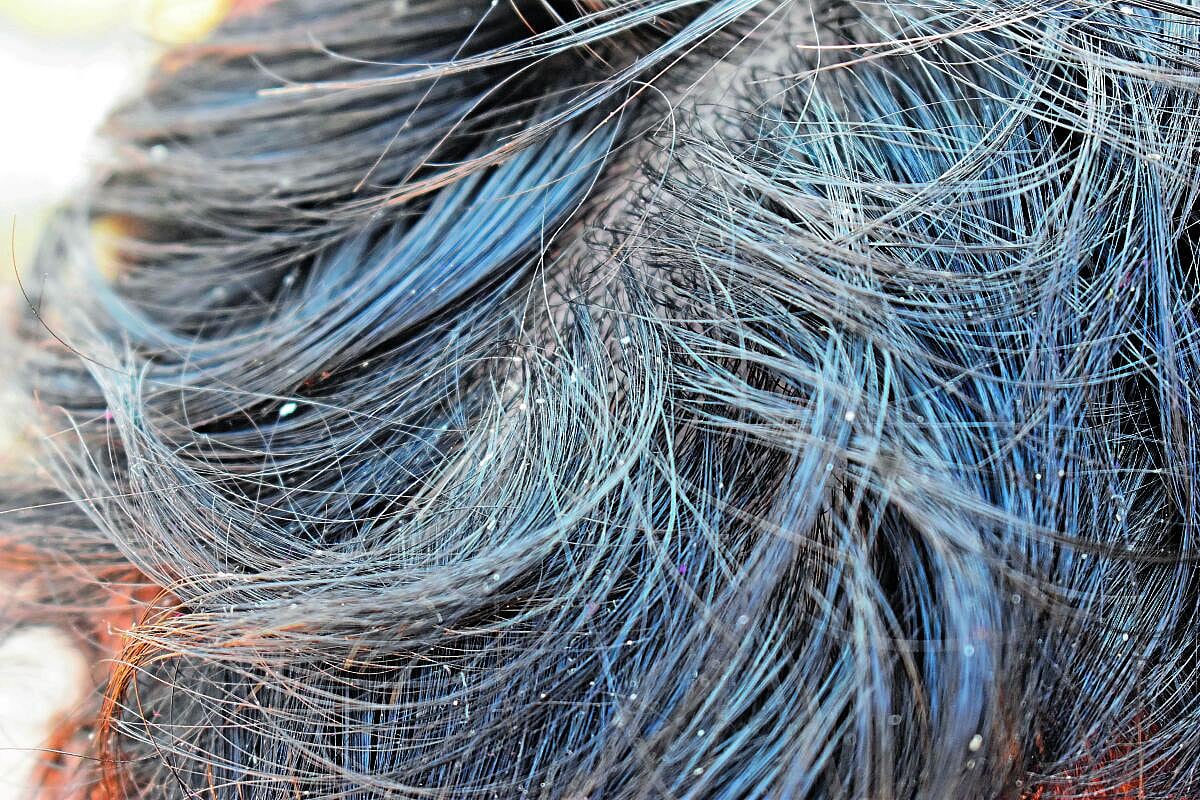 ಕ್ಷೇಮ – ಕುಶಲ: ತಲೆಹೊಟ್ಟಿನ ಕಿರಿ ಕಿರಿ