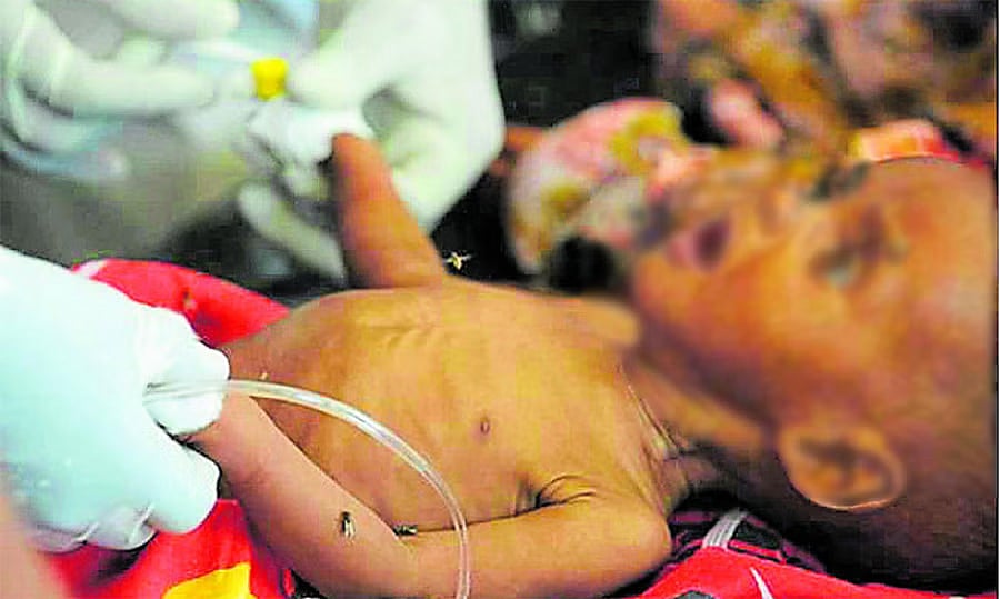 ಹಾವೇರಿ | ಅಪೌಷ್ಟಿಕತೆ ಸುಳಿಯಲ್ಲಿ 510 ಮಕ್ಕಳು: ಸ್ಯಾಮ್– ಮ್ಯಾಮ್ ಮಾಹಿತಿ