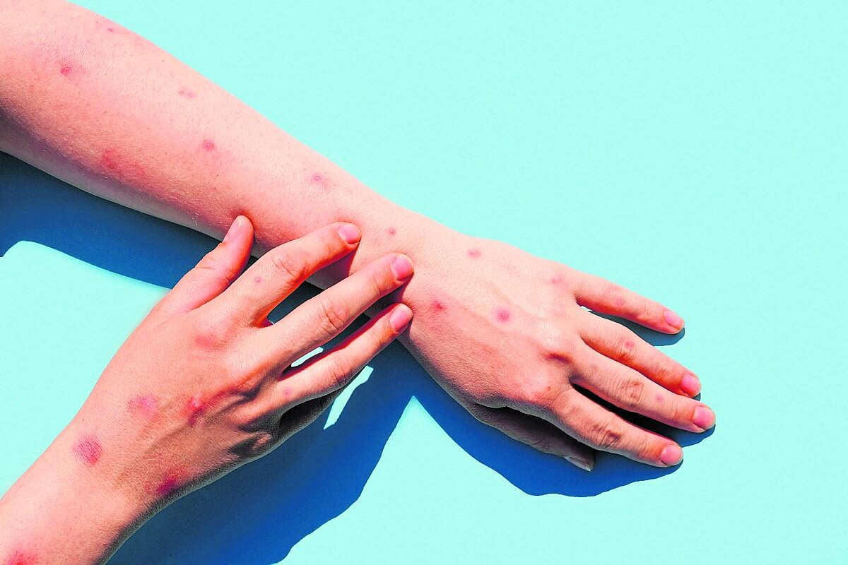 ಎಂ–ಪಾಕ್ಸ್‌ ಪತ್ತೆ ಕಿಟ್‌ ತಯಾರಿಕೆಗೆ CDSCO ಅನುಮತಿ: ಸೀಮೆನ್ಸ್ ಹೆಲ್ತಿನಿಯರ್ಸ್