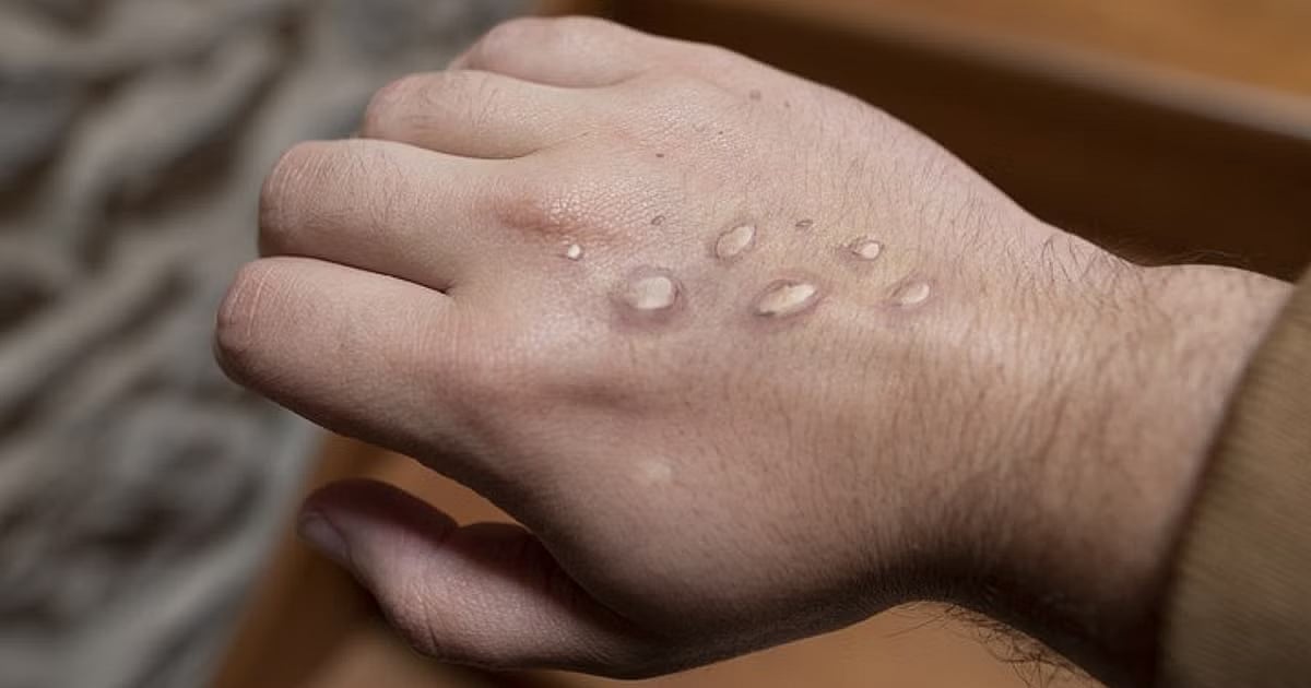 ಮಂಕಿ ಪಾಕ್ಸ್; ಪ್ರಕರಣ ವರದಿಯಾಗಿಲ್ಲ:  ಆರೋಗ್ಯಾಧಿಕಾರಿ ಡಾ.ರಾಖಿ ಮಾನೆ 