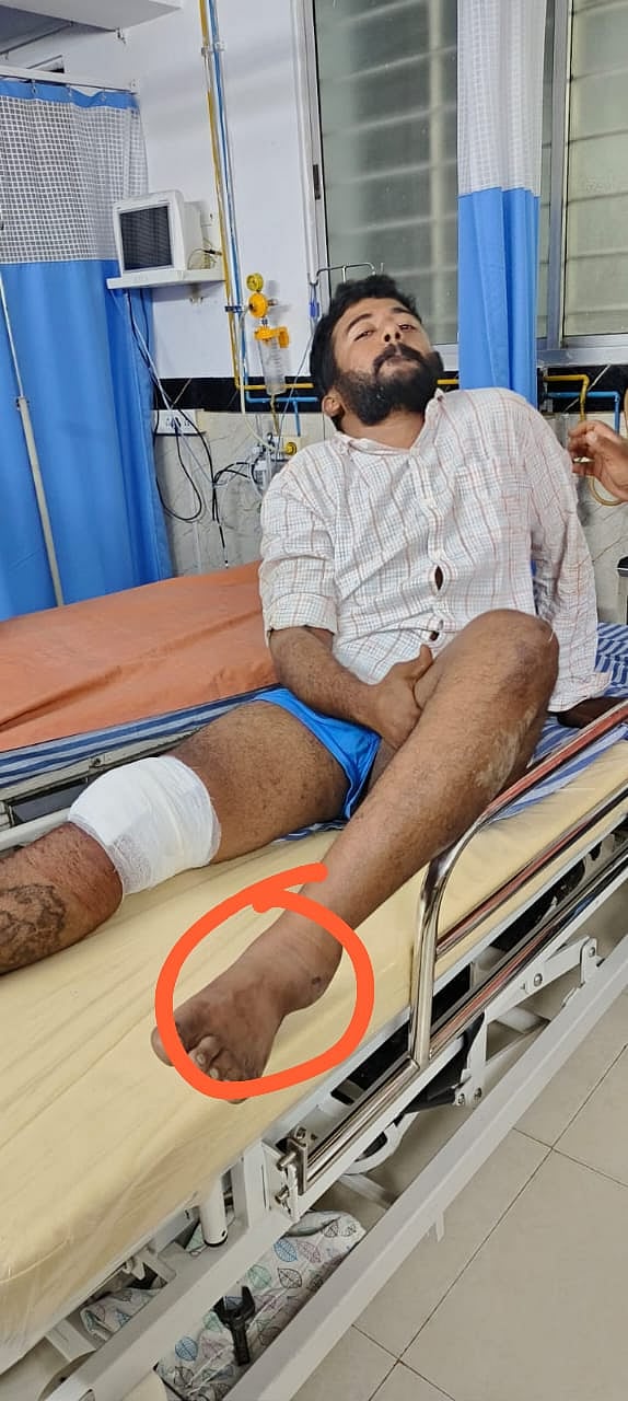 ಯುವಕನ ನಗ್ನಗೊಳಿಸಿ ಹಲ್ಲೆ ಪ್ರಕರಣ: ರೌಡಿಶೀಟರ್ ಕಾಲಿಗೆ ಗುಂಡು ಹಾರಿಸಿ ಬಂಧನ