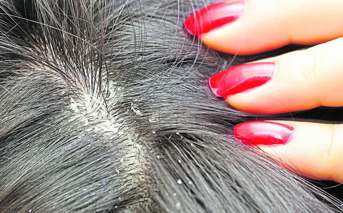 ತಲೆಹೊಟ್ಟಿಗಿದೆ ಪರಿಹಾರ