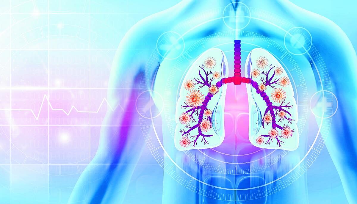 ಆಳ–ಅಗಲ | ಎಚ್‌ಎಂಪಿವಿ: ಸಾಮಾನ್ಯ ಸೋಂಕು ಅಪಾಯಕಾರಿ ಅಲ್ಲ