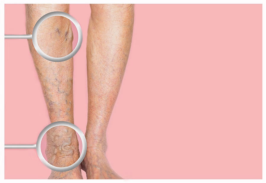 ಮಹಾರಾಷ್ಟ್ರದಲ್ಲಿ 225 ಜಿಬಿಎಸ್ ಪ್ರಕರಣ ಪತ್ತೆ: 12 ಸಾವು