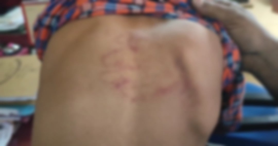 ಬಾಸುಂಡೆ ಬರುವಂತೆ ಪೆಟ್ಟು: ಚಿಕ್ಕನಾಯಕನಹಳ್ಳಿ  ಅಂಗನವಾಡಿ ಸಹಾಯಕಿ ವಿರುದ್ಧ ಆರೋಪ 