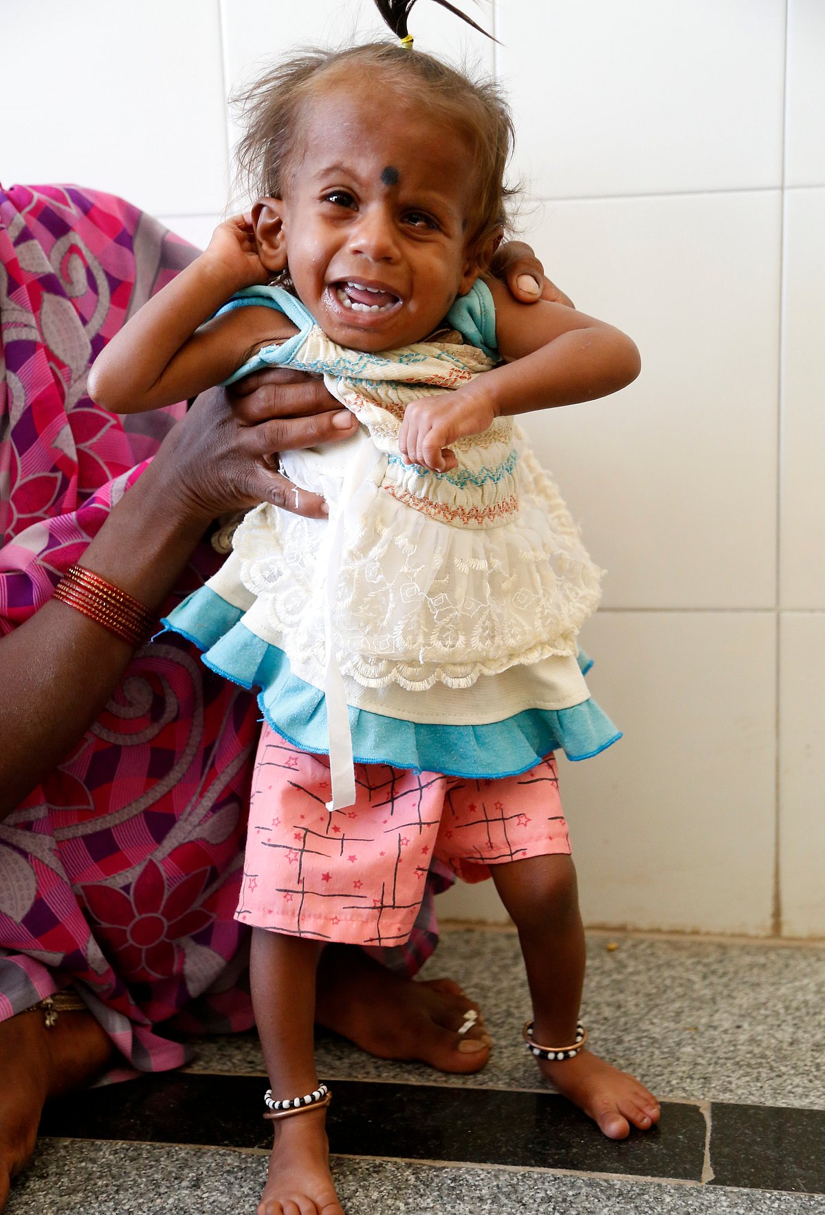 ತುಮಕೂರು: 1,579 ಮಕ್ಕಳಲ್ಲಿ ತೀವ್ರ ಅಪೌಷ್ಟಿಕತೆ