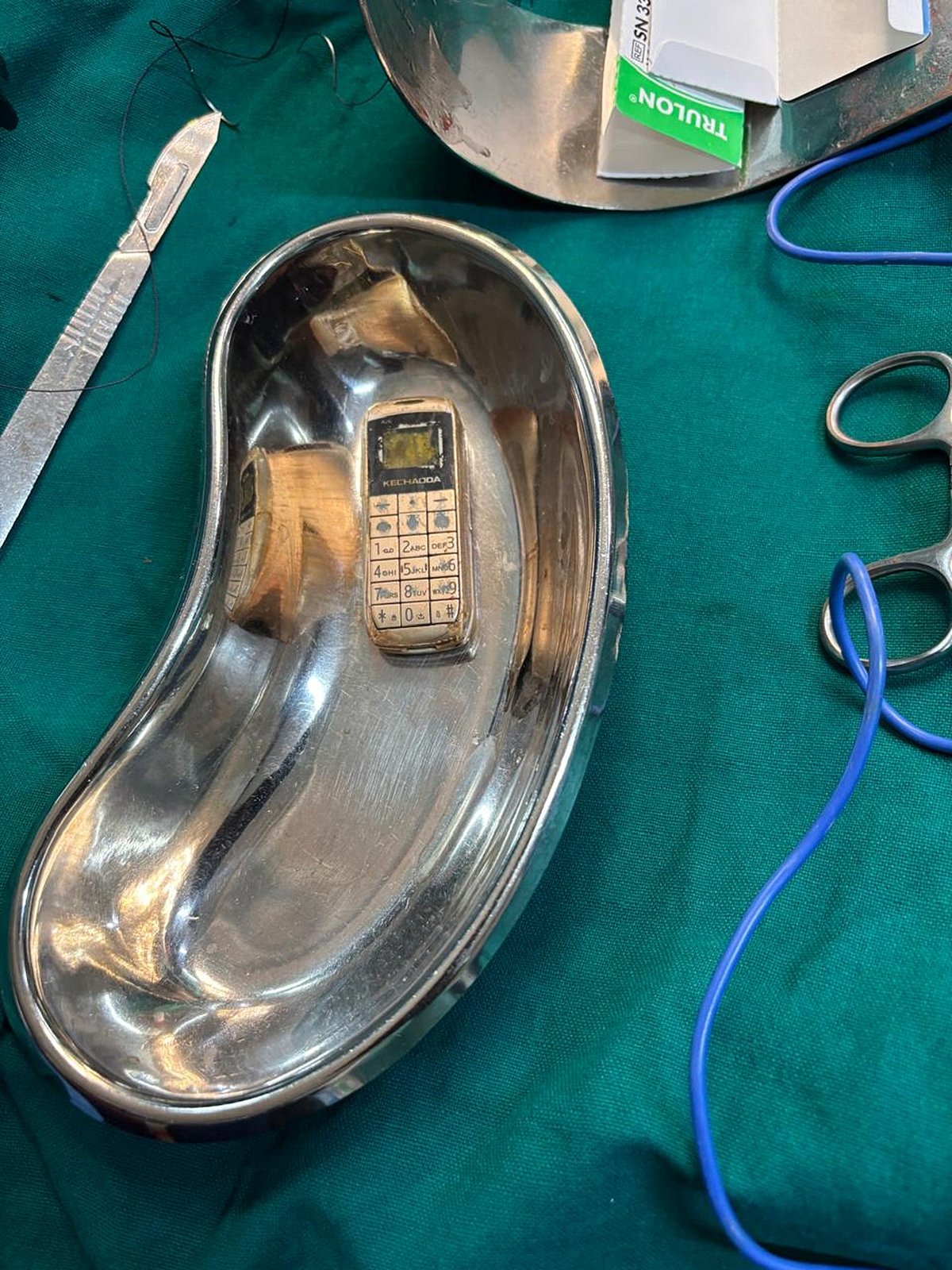 ಶಿವಮೊಗ್ಗ ಕೇಂದ್ರ ಕಾರಾಗೃಹ: ಕೈದಿ ಹೊಟ್ಟೆಯಲ್ಲಿ ಮೊಬೈಲ್ ಫೋನ್ 