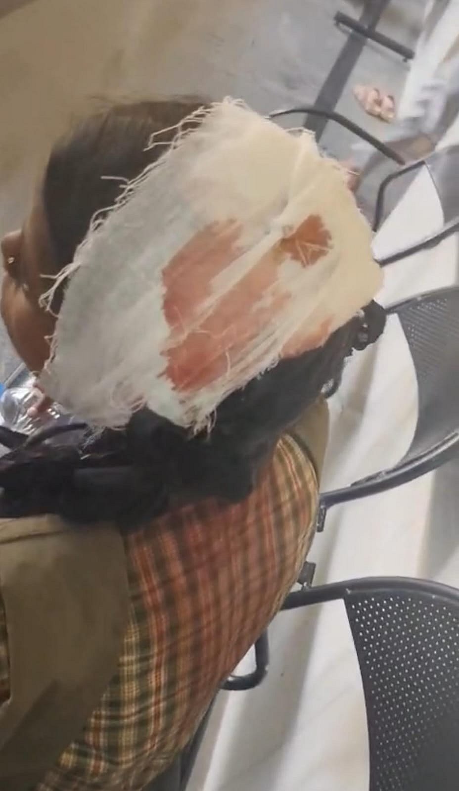 ಮಲ್ಕಾಪಲ್ಲಿ; ಶಾಲಾ ಚಾವಣಿ ಕುಸಿದು ಗಾಯ- ವಿದ್ಯಾರ್ಥಿನಿಗೆ ಮುಂದುವರೆದ ಚಿಕಿತ್ಸೆ