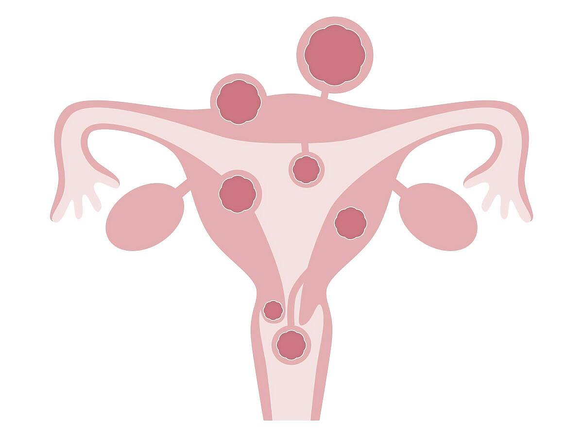 Health Awareness | ಫೈಬ್ರಾಯ್ಡ್‌: ಜಾಗ್ರತೆ ವಹಿಸಿ