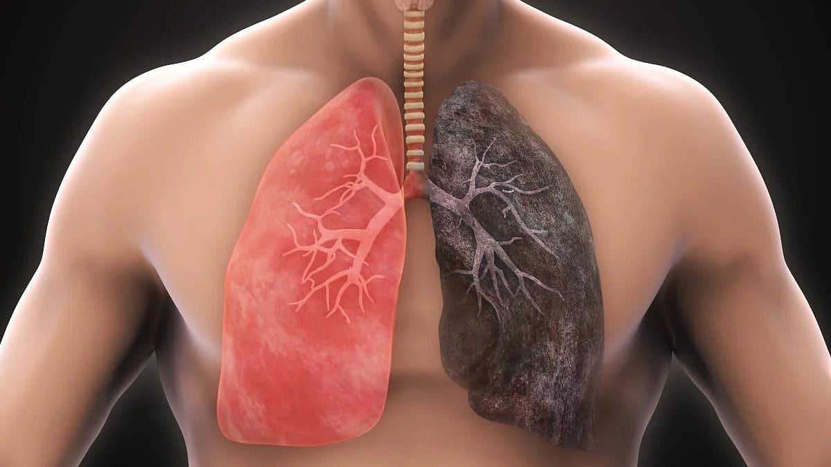 ಕ್ಷೀಣಿಸುತ್ತಿದೆ ಯುವಜನರ ಶ್ವಾಸಕೋಶ; ದೇಶದ ಭವಿಷ್ಯಕ್ಕೆ ಮಾರಕ: ತಜ್ಞರ ಎಚ್ಚರಿಕೆ