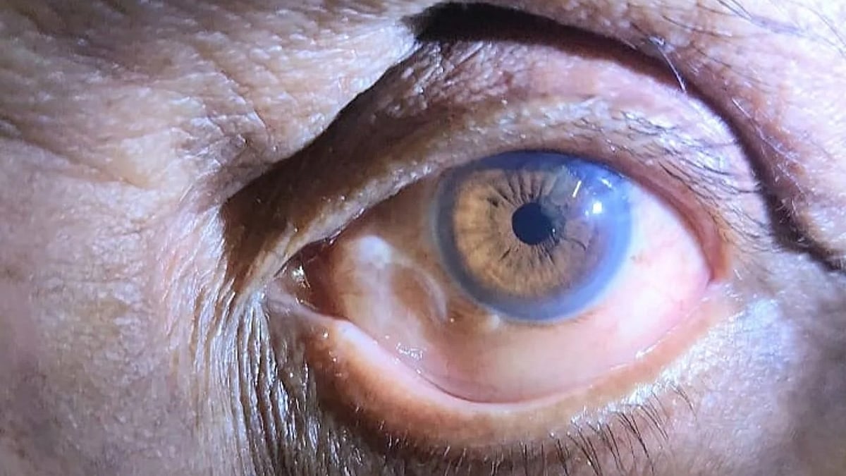 ಯಶಸ್ವಿ ಶಸ್ತ್ರಚಿಕಿತ್ಸೆ: ಕಣ್ಣಿನಿಂದ 10 ಸೆಂ.ಮೀ ಉದ್ದದ ಹುಳ ಹೊರಕ್ಕೆ