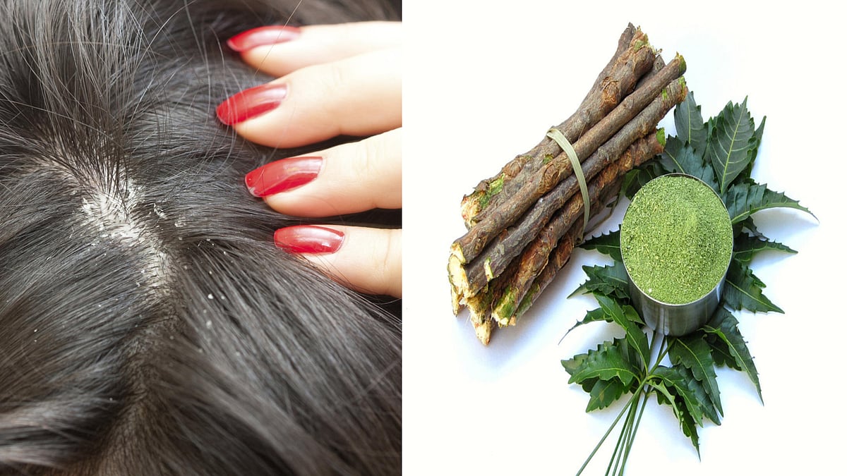 ತಲೆ ಹೊಟ್ಟಿನ ಸಮಸ್ಯೆಗೆ ಇಲ್ಲಿವೆ ಸರಳ ಮನೆ ಮದ್ದುಗಳು 