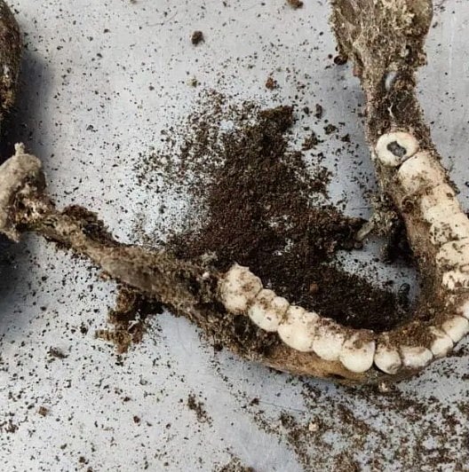 ಕೊತ್ತನೂರು ಅಸ್ಥಿಪಂಜರ ಪ್ರಕರಣ: ಹಲ್ಲು ಸೆಟ್‌ನಿಂದ ವ್ಯಕ್ತಿಯ ಗುರುತು ಪತ್ತೆ