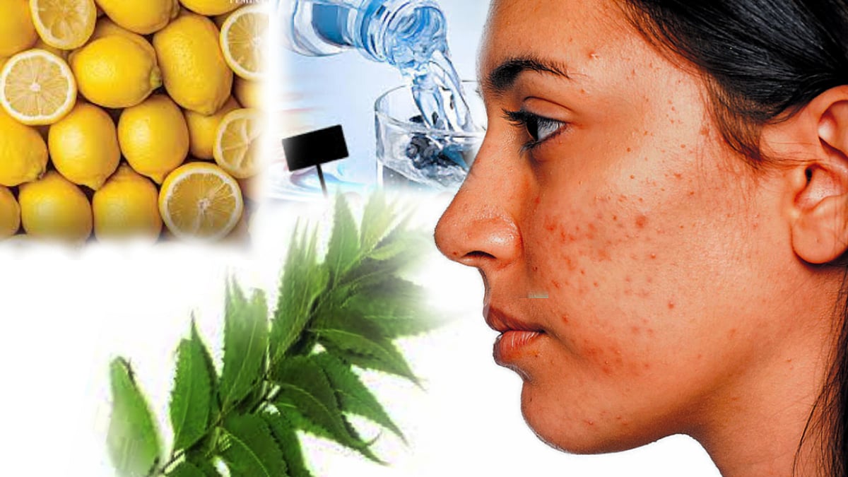ಮುಖದ ಅಂದಗೆಡಿಸುವ ಮೊಡವೆಗಳ ನಿವಾರಣೆಗೆ ಇಲ್ಲಿವೆ ಸರಳ ಮನೆಮದ್ದುಗಳು