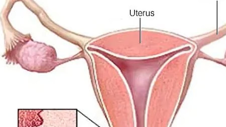 ಗರ್ಭಕಂಠದ ಕ್ಯಾನ್ಸರ್ ನಿರ್ಮೂಲನಾ ದಿನ: ಆರಂಭಿಕ ತಪಾಸಣೆ, ಲಸಿಕೆಯೇ ಪರಿಹಾರ