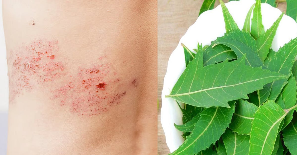 Ayurveda Medicine | ಹುಳುಕಡ್ಡಿ ನಿಯಂತ್ರಣಕ್ಕೆ ಇಲ್ಲಿವೆ ಸರಳ ಮನೆ ಮದ್ದುಗಳು
