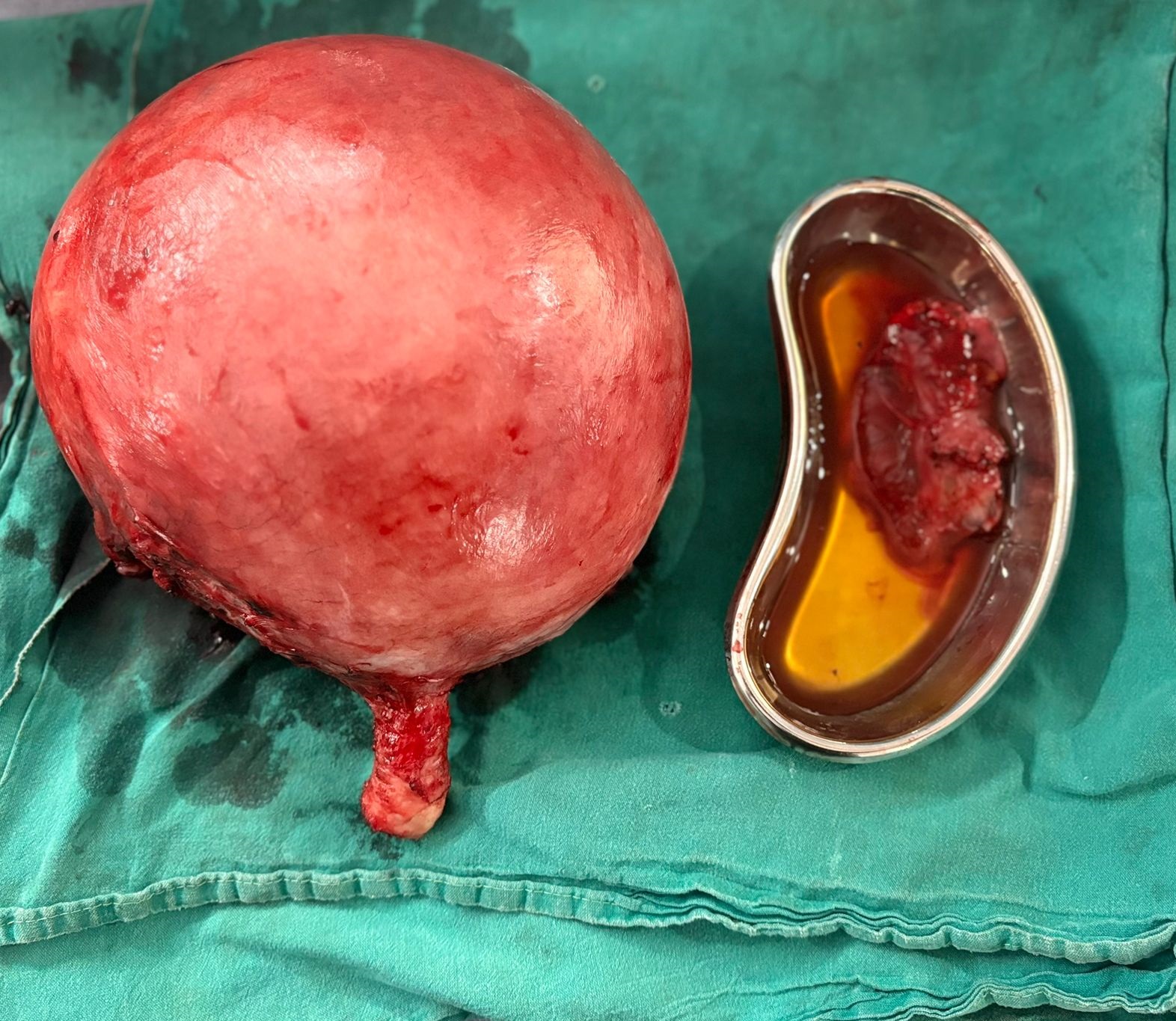 ಮಹಿಳೆಯೊಬ್ಬರ ಗರ್ಭದಲ್ಲಿ ಬೆಳೆದಿದ್ದ 3.7 ಕೆಜಿ ತೂಕದ ಮಾಂಸದ ಗಡ್ಡೆ