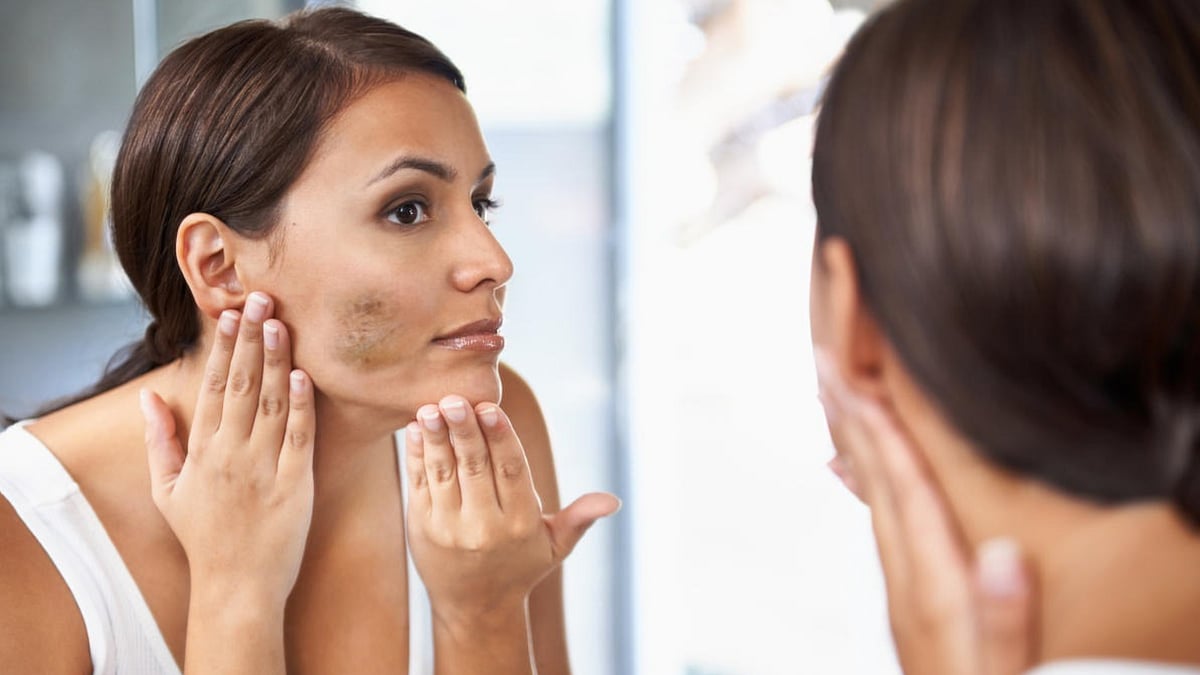 ಮುಖದ ಅಂದಕ್ಕೆ ಅಡ್ಡಿ ಮಾಡುವ ಸುಟ್ಟ ಕಲೆಗಳಿಗೆ ಇಲ್ಲಿವೆ ಸರಳ ಮನೆಮದ್ದುಗಳು