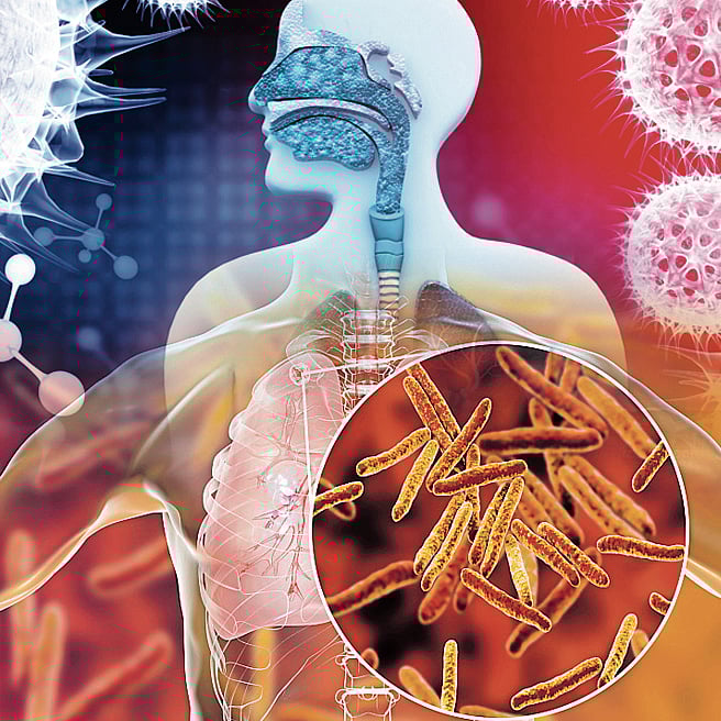 ಸಂಪಾದಕೀಯ | ಕ್ಷಯದ ತಡೆಗೆ ದಿಟ್ಟ ಹೋರಾಟ: ಸಾಗಬೇಕಾದ ದಾರಿ ಇನ್ನೂ ಇದೆ