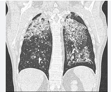 ಮಹಿಳೆಗೆ ಅಪರೂಪದ ಕಾಯಿಲೆ: ಸ್ಪರ್ಶ್‌ ಆಸ್ಪತ್ರೆ ವೈದ್ಯರಿಂದ ಯಶಸ್ವಿ ಚಿಕಿತ್ಸೆ