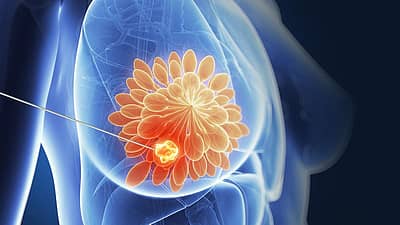 ಮೊಲೆ ತೊಟ್ಟಿನ ಸೋಂಕು: ಮಾಸ್ಟೈಟಿಸ್‌ ಅಥವಾ ಸ್ತನದ ಸೋಂಕು ಇದ್ದಾಗ, ಬ್ಯಾಕ್ಟಿರಿಯಾ ಹಾಲಿನಲ್ಲಿ ಬೆರೆತು ವಿಷಯುಕ್ತವಾಗಬಹುದು.