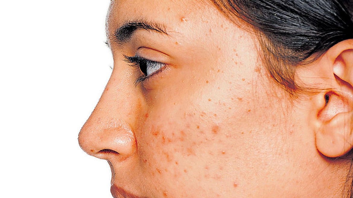 Skin Care: ಚರ್ಮದ ಕಾಂತಿ ಕಳೆದುಕೊಳ್ಳಲು ಒತ್ತಡವೇ ಕಾರಣ!