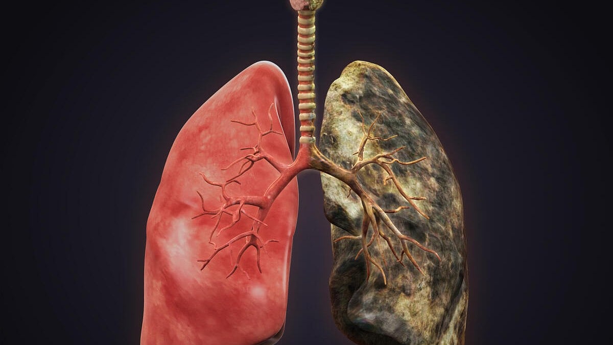 ಶ್ವಾಸಕೋಶದ ಕ್ಯಾನ್ಸರ್‌ಗೆ ಕಾರಣಗಳಿವು