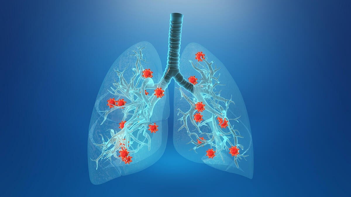 ಇವೆಲ್ಲ ನ್ಯುಮೋನಿಯಾ ಲಕ್ಷಣಗಳು; ಕಡೆಗಣಿಸದಿರಿ