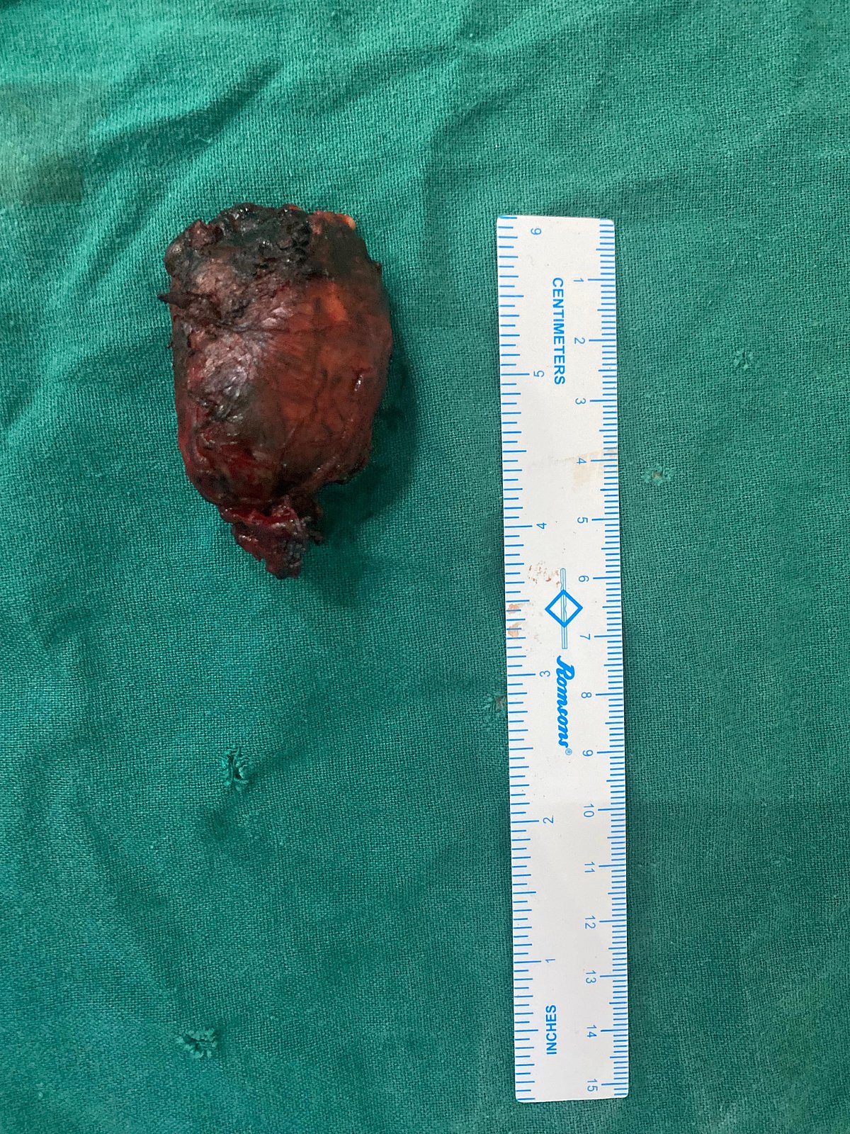 ಶಿವಮೊಗ್ಗ | ಮೆಗ್ಗಾನ್ ಆಸ್ಪತ್ರೆಯಲ್ಲಿ ವೃದ್ಧೆಗೆ ಉಚಿತ ಶಸ್ತ್ರಚಿಕಿತ್ಸೆ