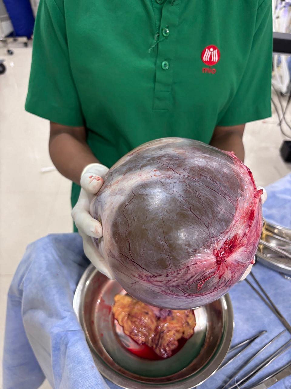 ತೀರ್ಥಹಳ್ಳಿ | 6 ಕೆ.ಜಿ ತೂಕದ ಗಡ್ಡೆ ಹೊರತೆಗೆದ ವೈದ್ಯರು