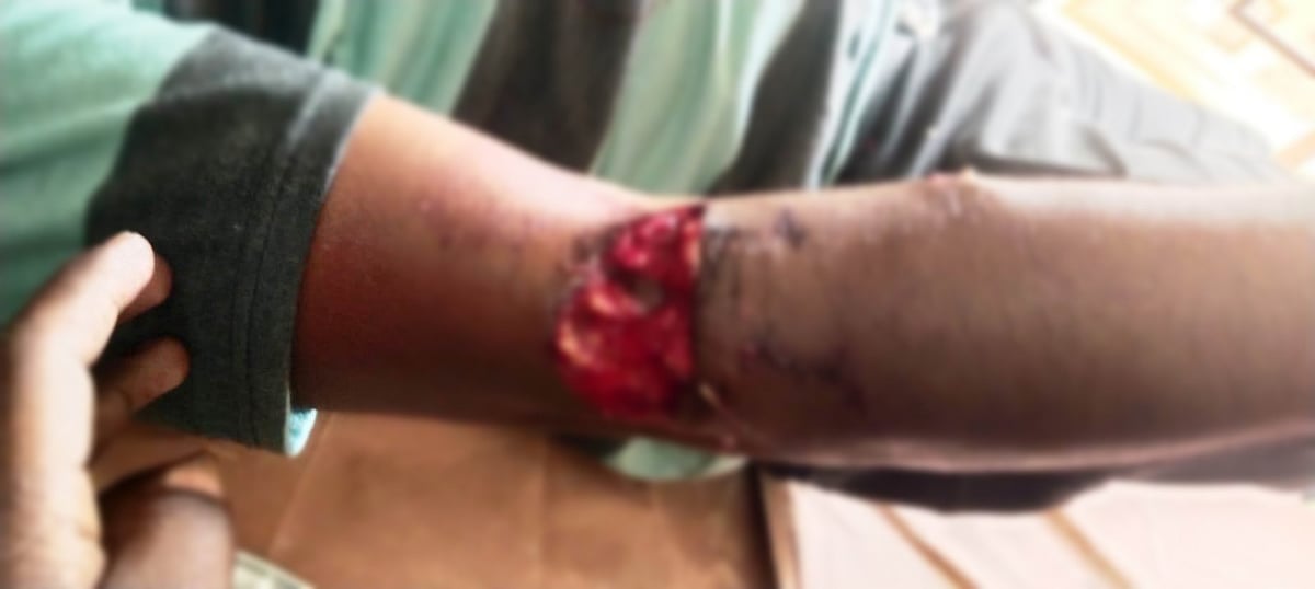 ಬಂಟ್ವಾಳ: ವಿದ್ಯುತ್ ಮೀಟರ್ ರೀಡರ್‌ಗೆ ನಾಯಿ ಕಡಿತ