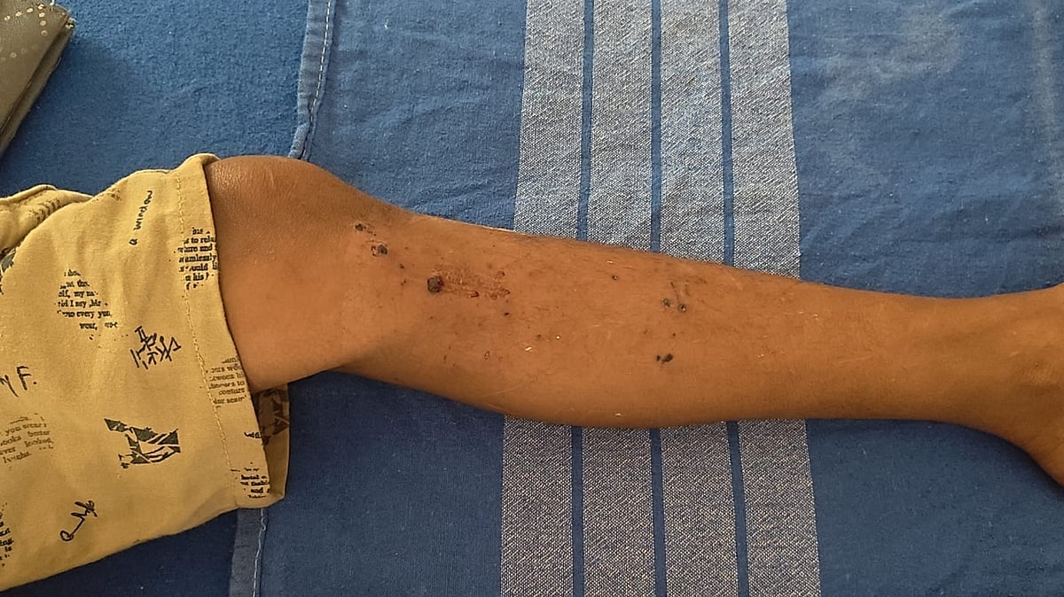 ಬೆಳ್ತಂಗಡಿ: ಚೆಂಡಿನಂಥ ವಸ್ತು ಸ್ಪೋಟಗೊಂಡು ಬಾಲಕನಿಗೆ ಗಾಯ