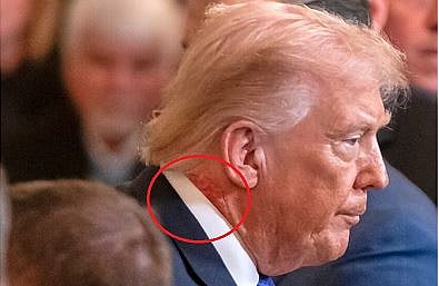 ಟ್ರಂಪ್ ಕುತ್ತಿಗೆಯಲ್ಲಿನ ಕೆಂಪು ಕಲೆಗೆ ‍‘ಸ್ಕಿನ್ ಕ್ರೀಮ್‌’ ಕಾರಣವೆಂದ ಶ್ವೇತಭವನ