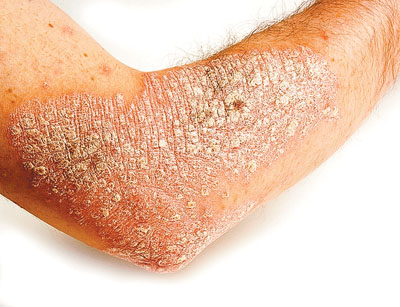 ಸೋರಿಯಾಸಿಸ್ ನಿಮ್ಮನ್ನು ಸೋಲಿಸದಿರಲಿ