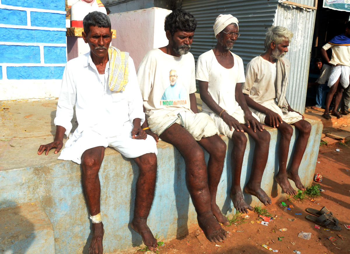 ಯಾದಗಿರಿಯ ಮೋಟ್ನಳ್ಳಿಯಲ್ಲಿ 150 ಜನರಲ್ಲಿ ‘ಆನೆಕಾಲು’ ಲಕ್ಷಣ!