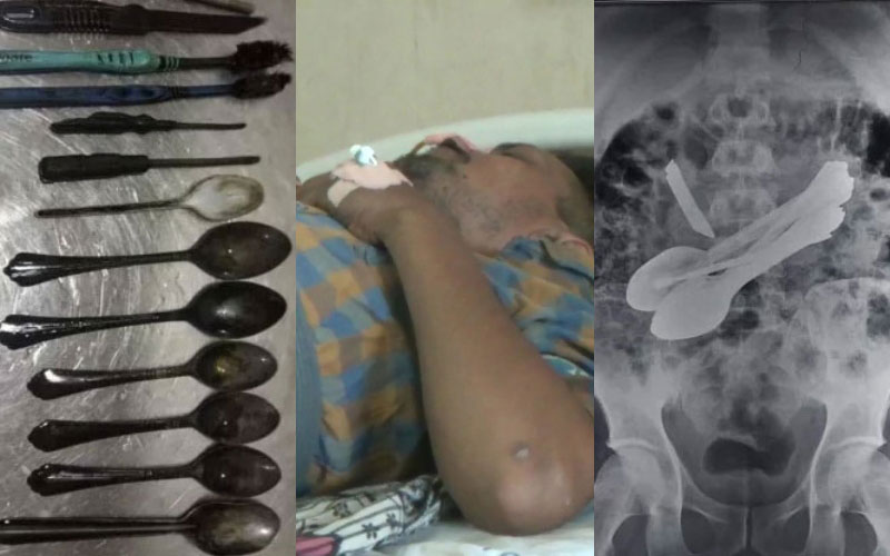 ವ್ಯಕ್ತಿಯೊಬ್ಬನ ಹೊಟ್ಟೆಯಲ್ಲಿ ಸಿಕ್ಕವು 8 ಚಮಚ, 2 ಬ್ರಷ್‌, 1 ಚಾಕು, ಇನ್ನಷ್ಟು!
