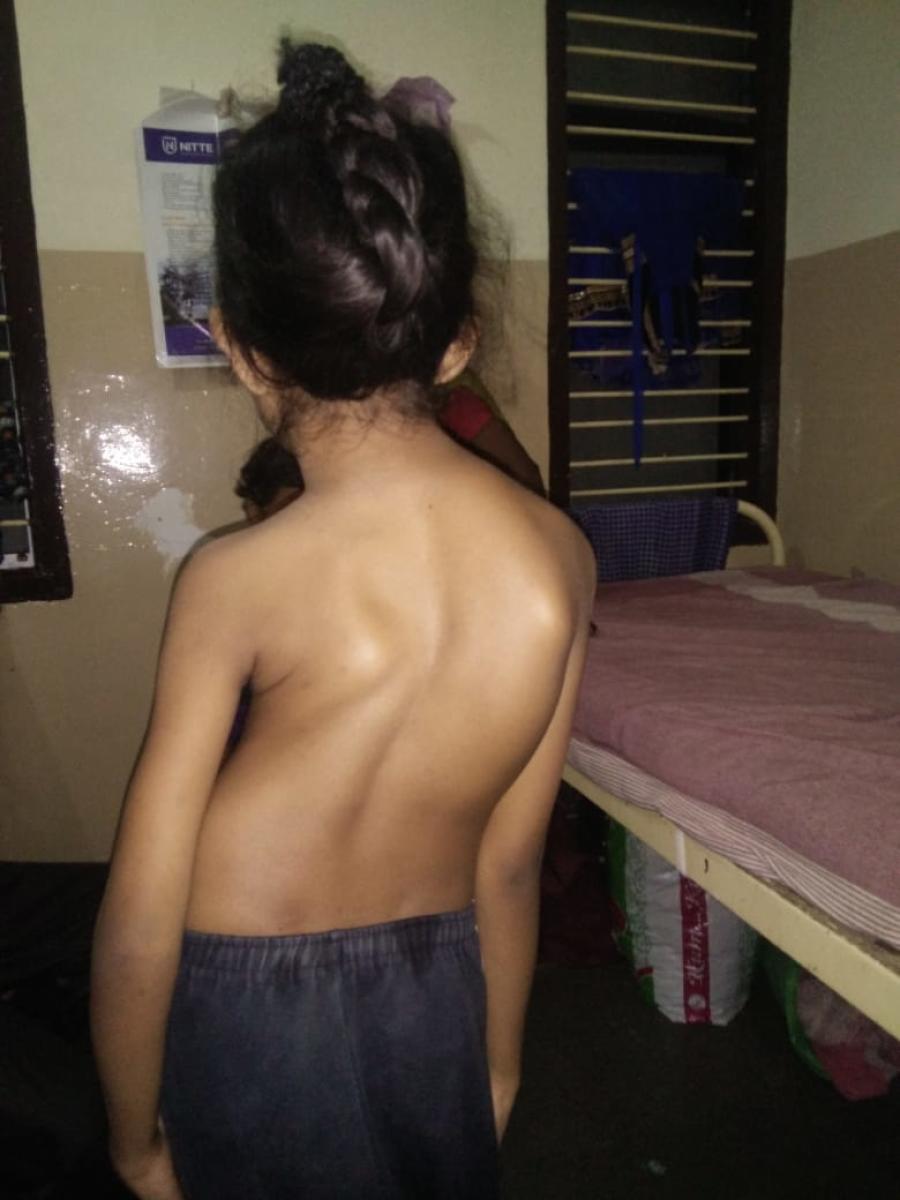 ಬಾಗು ಬೆನ್ನು ಬಾಲಕಿಗೆ ಬದುಕು ನೀಡಿದ ಕೋಟೆ ಫೌಂಡೇಷನ್