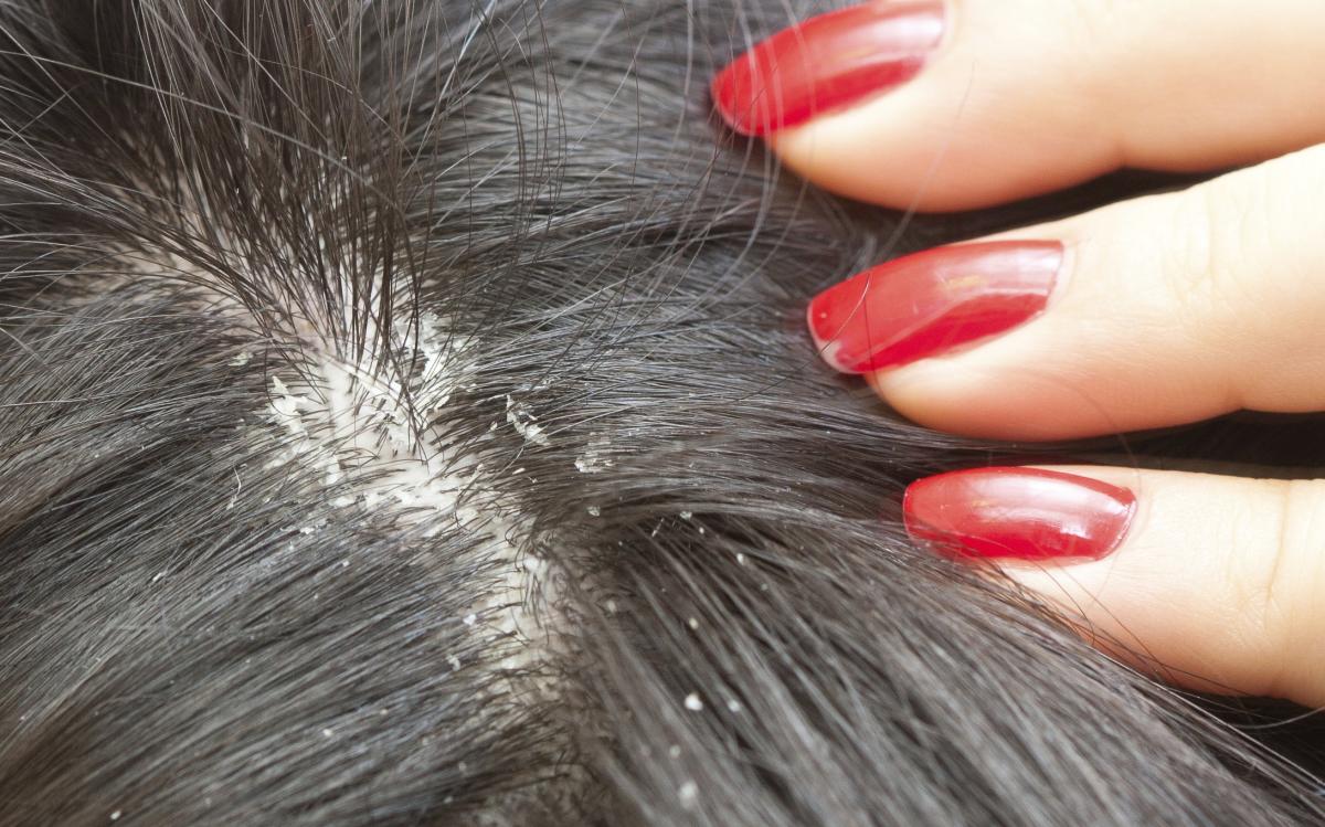 ತಲೆಹೊಟ್ಟು ನಿವಾರಣೆಗೆ ಕಹಿಬೇವು