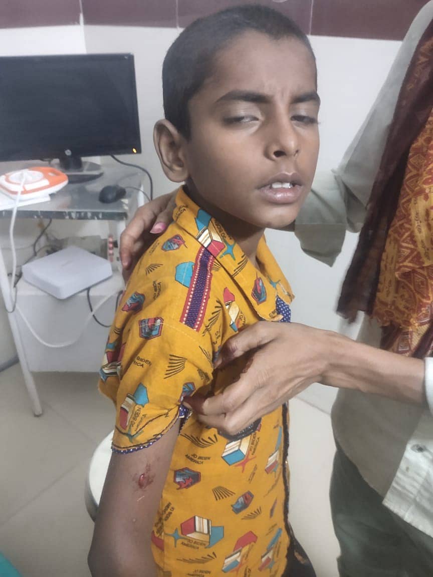 ಹಟ್ಟಿ ಪಟ್ಟಣದಲ್ಲಿ ಹುಚ್ಚು ನಾಯಿ ಕಡಿತಕ್ಕೆ ಒಳಗಾದ ಬಾಲಕ