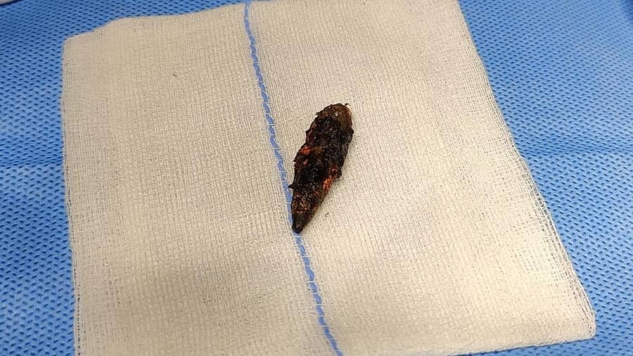 ವ್ಯಕ್ತಿಯ ತಲೆಯಲ್ಲಿದ್ದ ಗುಂಡು