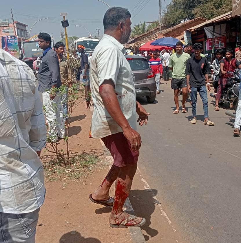 ಶಿರಾಳಕೊಪ್ಪದಲ್ಲಿ ಭಾನುವಾರ ನಡೆದ ಸಂತೆಯಲ್ಲಿ ಸಂಭವಿಸಿದ ಸ್ಫೋಟಕ್ಕೆ ವ್ಯಾಪಾರಿ ಅಂಥೋನಿ ಗಾಯಗೊಂಡಿರುವುದು