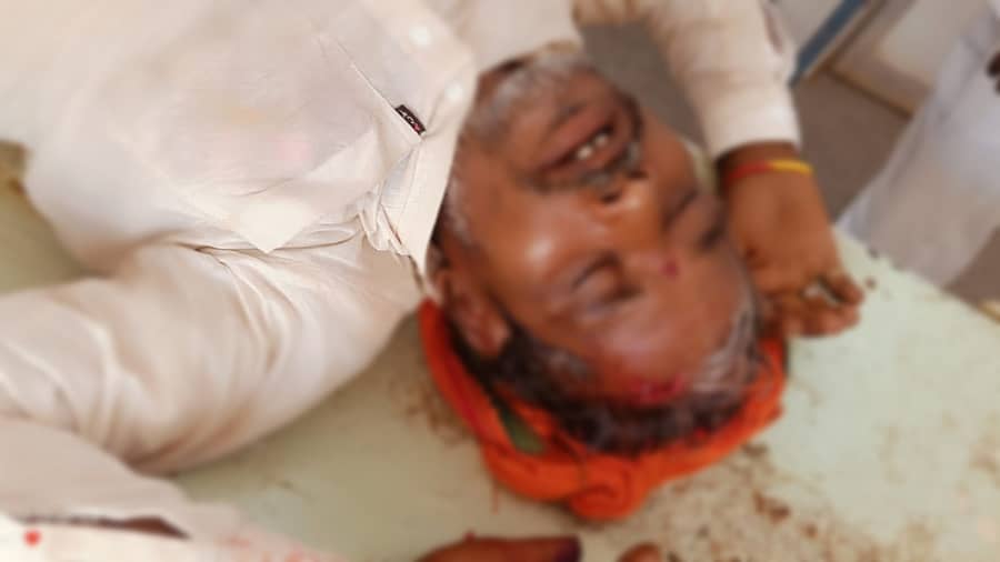 ಸುರಪುರ ತಾಲ್ಲೂಕಿನ ಬಾದ್ಯಾಪುರ ಗ್ರಾಮದಲ್ಲಿ ಮತದಾನ ವೇಳೆ ನಡೆದ ಗಲಾಟೆಯಲ್ಲಿ ಗಾಯಗೊಂಡ ಭೀಮಣ್ಣ ಬ್ಯಾಳಿ