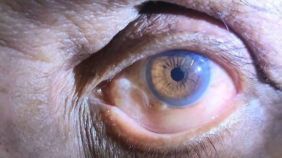 ವ್ಯಕ್ತಿಯ ಕಣ್ಣಿನೊಳಗೆ ಇರುವ 10 ಸೆಂ.ಮೀ ಉದ್ದದ ಹುಳ
