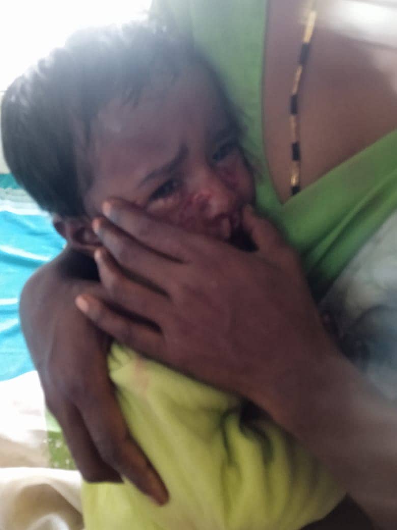 ಇಳಕಲ್‌ನಲ್ಲಿ ಸೋಮವಾರ ಹುಚ್ಚು ನಾಯಿ ಕಡಿತದಿಂದ ಗಾಯಗೊಂಡ ಮಗು