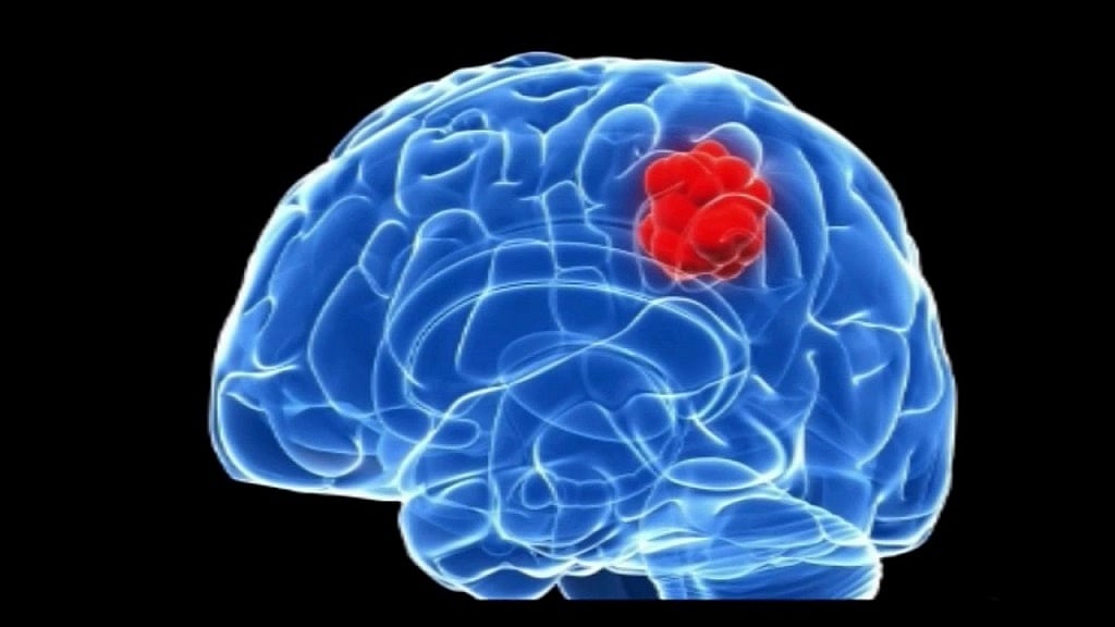 Brain Tumor Symptoms: ಬ್ರೈನ್ ಟ್ಯೂಮರ್: ಆರಂಭದಲ್ಲೇ ಪತ್ತೆ ಹಚ್ಚುವುದು ಹೇಗೆ ...