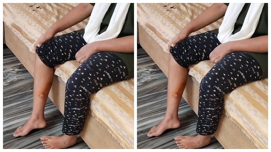 <div class="paragraphs"><p>ಬಾಲಕಿಯ ಕಾಲು ಗಾಯಗೊಂಡಿರುವುದು</p></div>