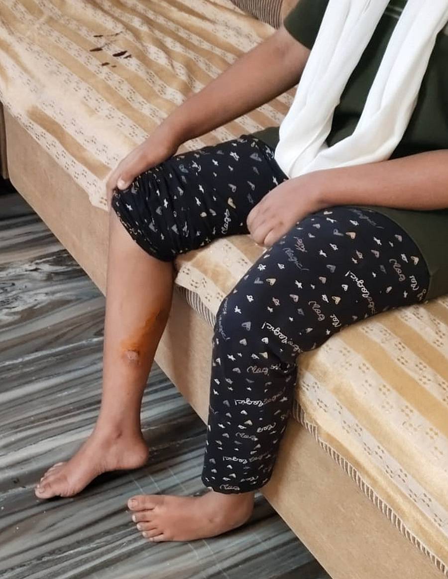 ಬಾಲಕಿಯ ಕಾಲು ಗಾಯಗೊಂಡಿರುವುದು