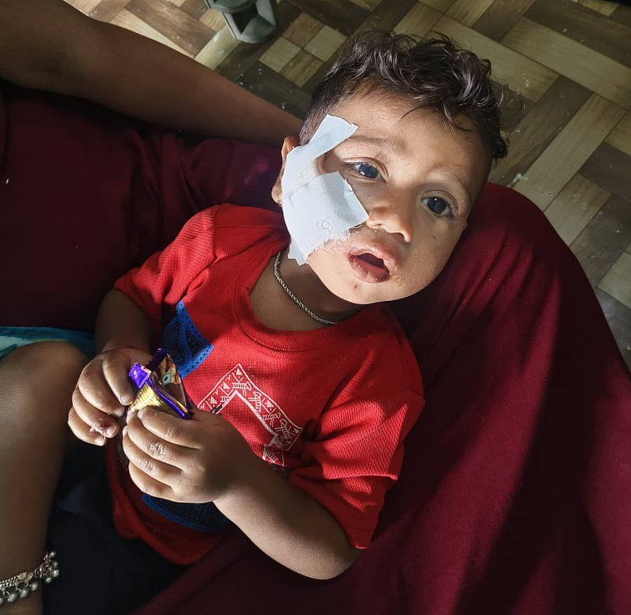 ಚಿಕ್ಕೋಡಿ ಪಟ್ಟಣದಲ್ಲಿ ಬೀದಿನಾಯಿಕಡಿತಕ್ಕೊಳಗಾದ ಮಗು ಋತ್ವಿಕ